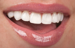 Cosmetic Veneers